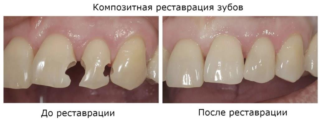 Реставрация зубов - стоматология Элит, Краснодар