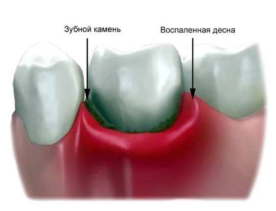 Лечение гингивита - стоматология Элит, Краснодар