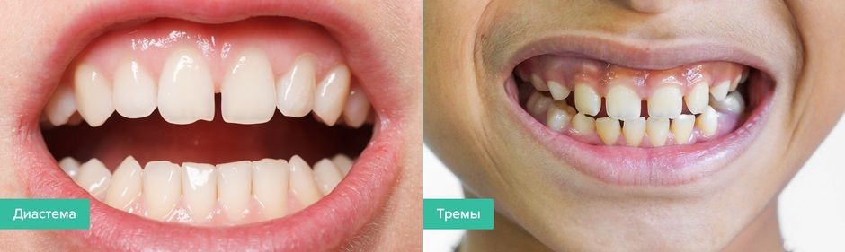 Тремы - стоматология Элит, Краснодар