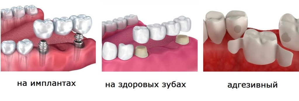 Мостовидный протез - стоматология Элит, Краснодар