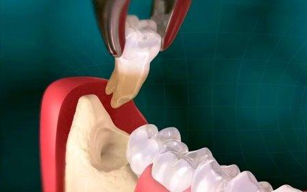 Удаление зуба мудрости - стоматология Элит, Краснодар